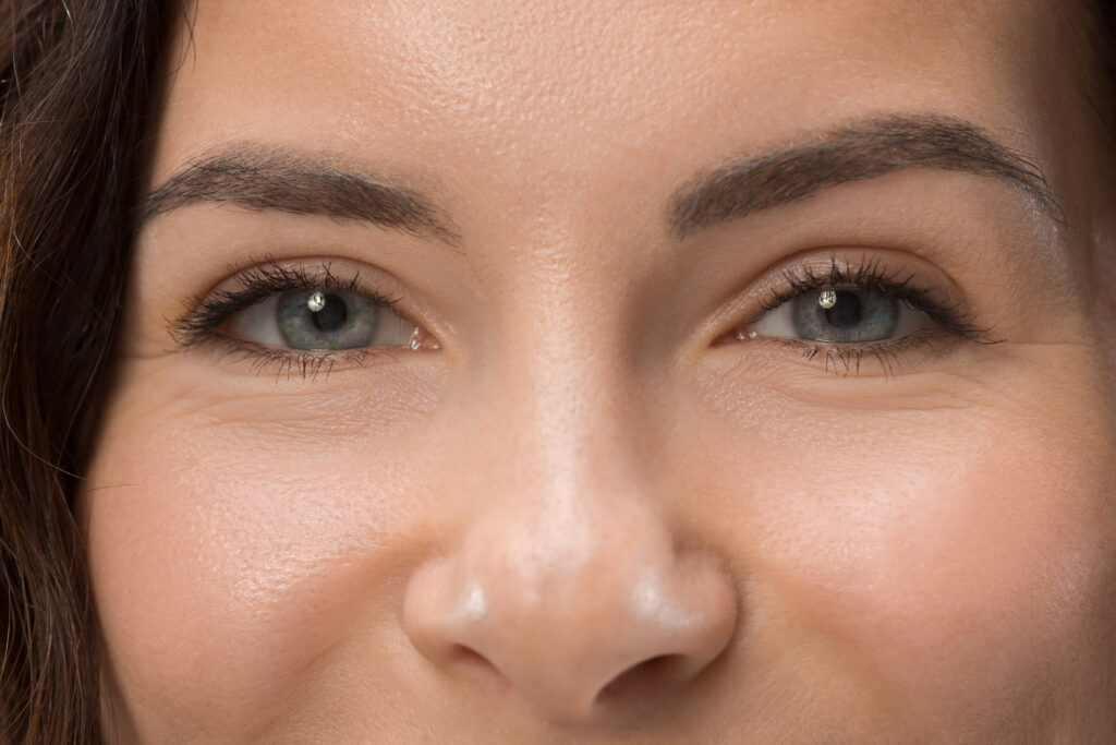 UPPER LID BLEPHAROPLASTY