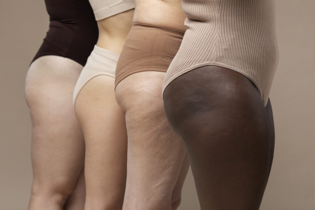 cellulite